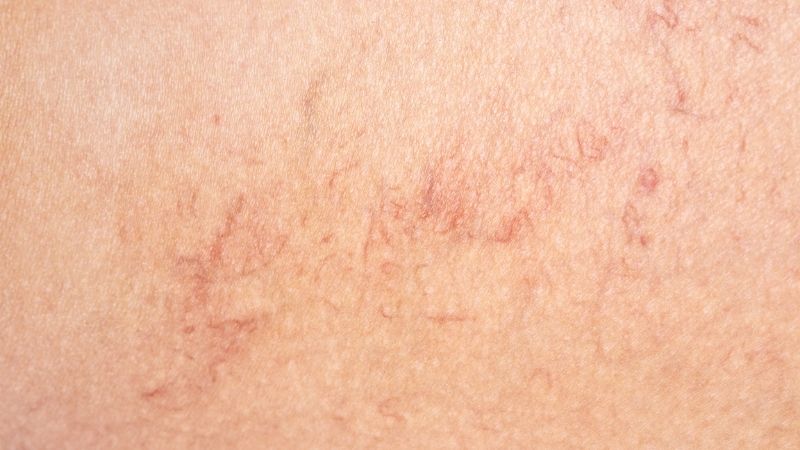 Nổi mao mạch là hiện tượng các mạch máu li ti giãn nở hoặc vỡ, hiện rõ mạng nhện đỏ