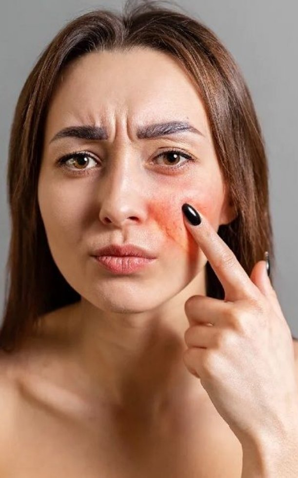 Cách chăm sóc da mỏng, yếu, nổi gân máu trở nên khỏe mạnh, rạng ngời hơn