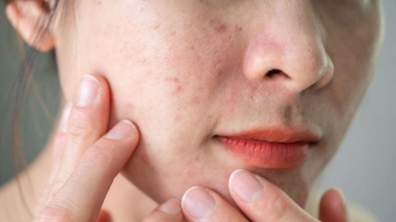 Do lạm dụng mỹ phẩm mạnh, kem trộn, tia UV và chăm sóc sai cách làm mòn lớp biểu bì