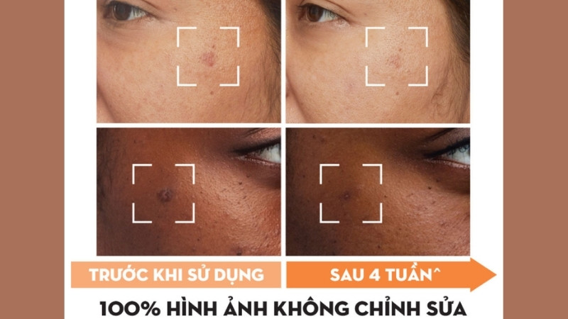 Ưu điểm là làm sáng da nhanh, thấm tốt; nhược điểm là có mùi hương và châm chích Ưu điểm là làm sáng da nhanh, thấm tốt; nhược điểm là có mùi hương và châm chích