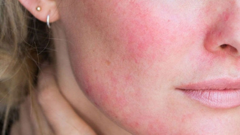 Da mặt thường ngứa ngáy, nóng rát và sưng tấy nhẹ kèm theo các mảng đỏ khó chịu