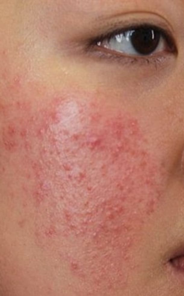 Da bị kích ứng mỹ phẩm: Nguyên nhân, dấu hiệu và cách xử lý nhanh