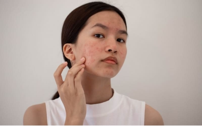 Nhiều trường hợp kích ứng mỹ phẩm có thể tự hết.