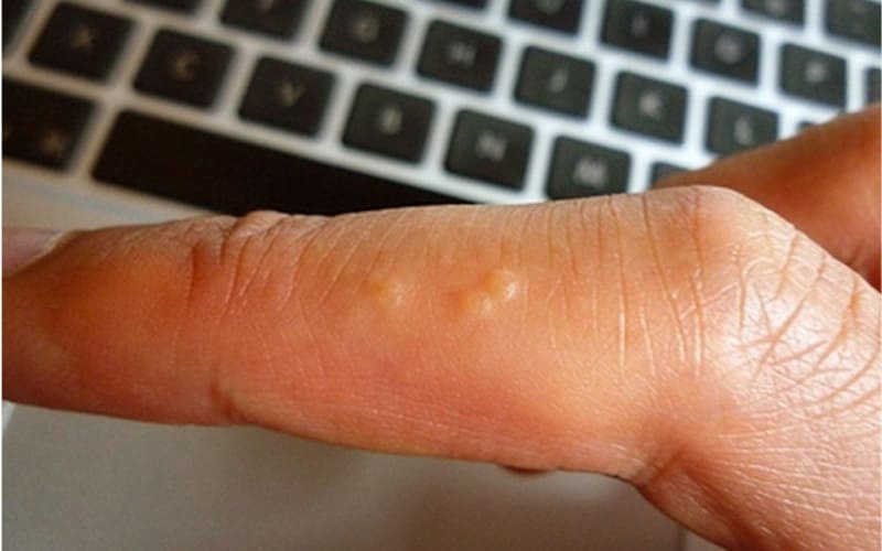 Nhiều yếu tố dị ứng và kích ứng có thể gây.