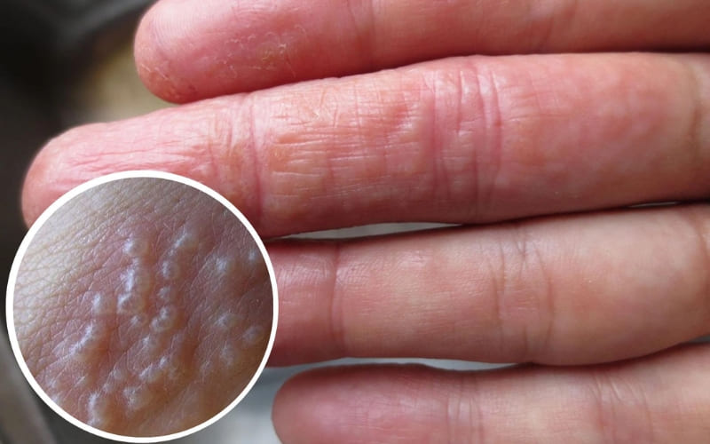 Người bệnh dễ nhận thấy mụn nước kèm ngứa.