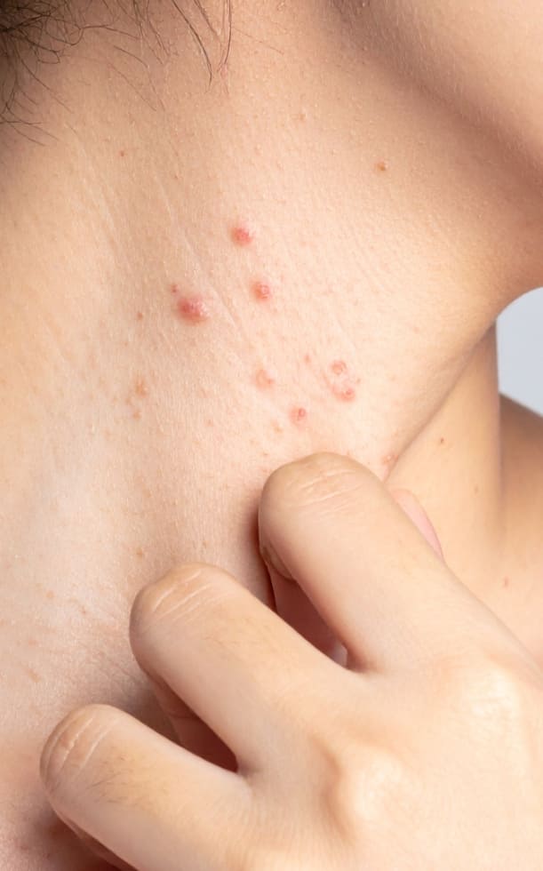 Viêm da nổi mụn nước: Nguyên nhân, dấu hiệu và cách điều trị