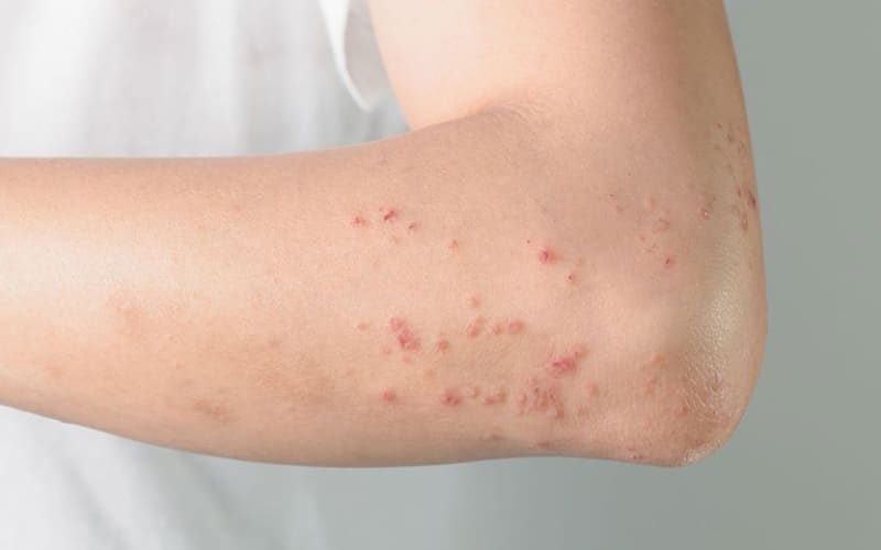 Các nốt mụn nước thường chứa dịch trong.