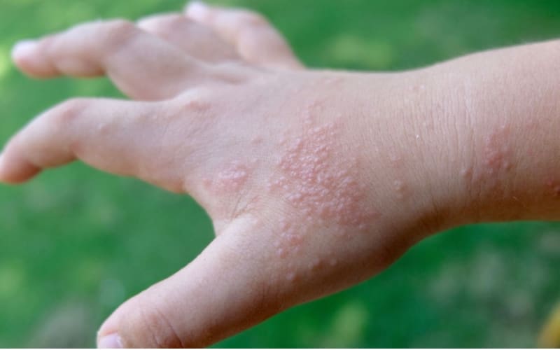 Một số mụn nước nhẹ có thể tự khỏi.