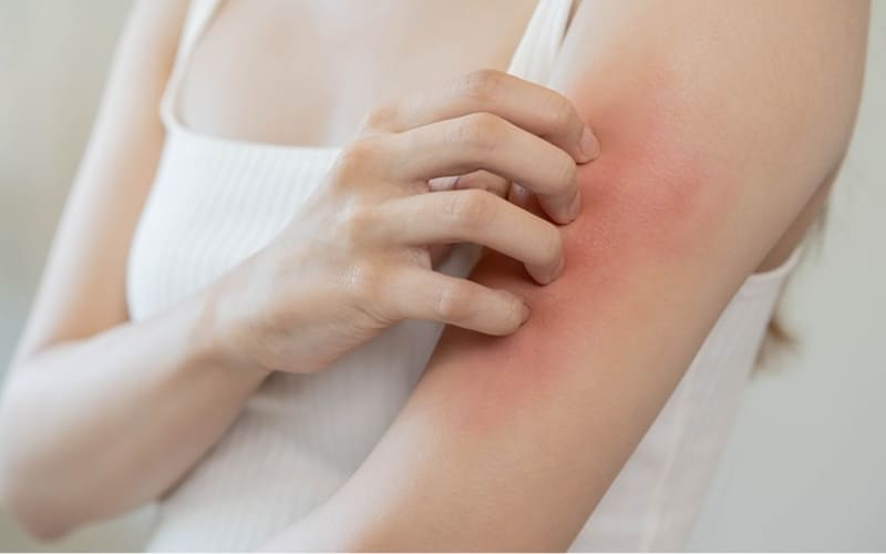 Người bệnh nên hạn chế tiếp xúc hóa chất gây kích ứng.