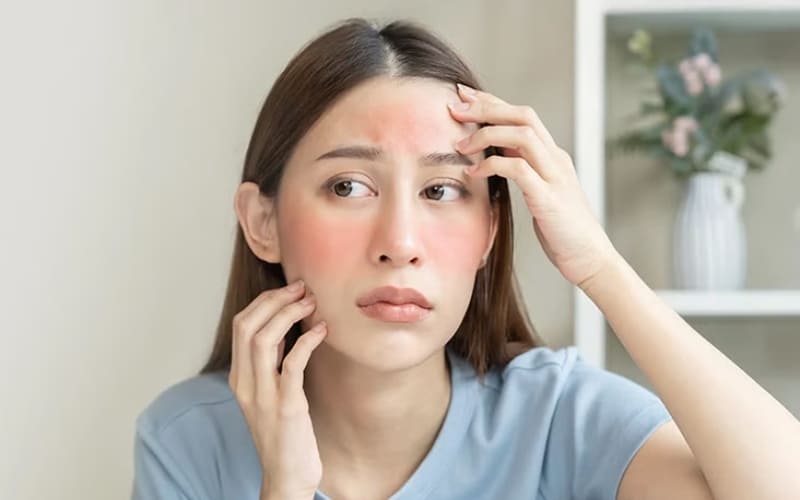 Da xuất hiện đỏ rát và khô sau nắng