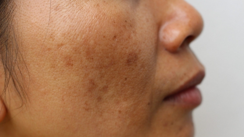 Da mặt xuất hiện các mảng sậm màu