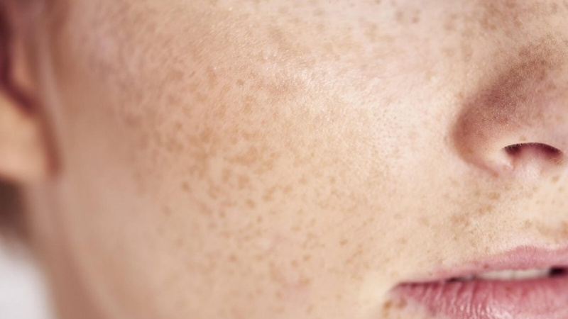 Nám da là hiện tượng rối loạn sắc tố