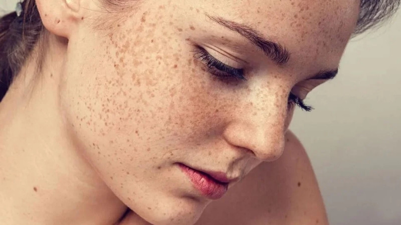 Bỏ qua chăm sóc da hằng ngày có thể khiến tình trạng nám trầm trọng hơn