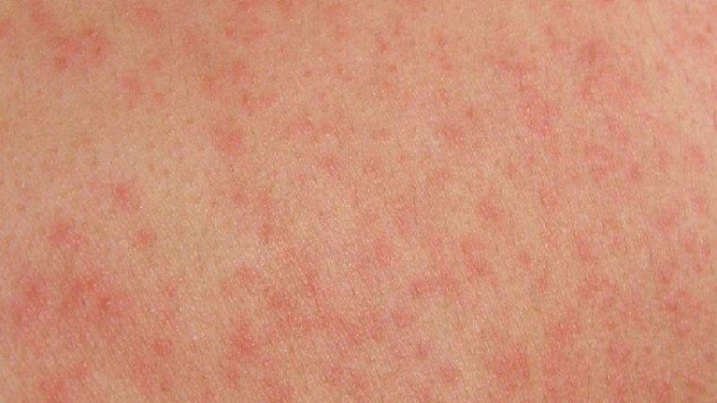 Nguyên nhân khiến da xuất hiện đốm đỏ