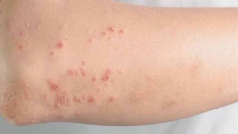 Da xuất hiện đốm đỏ là gì?