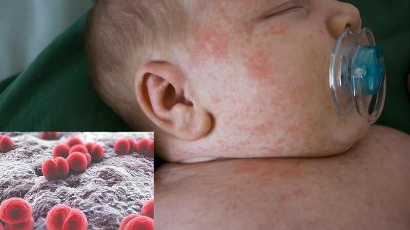 Bệnh viêm màng não mô cầu là gì? Bệnh viêm màng não mô cầu là gì?