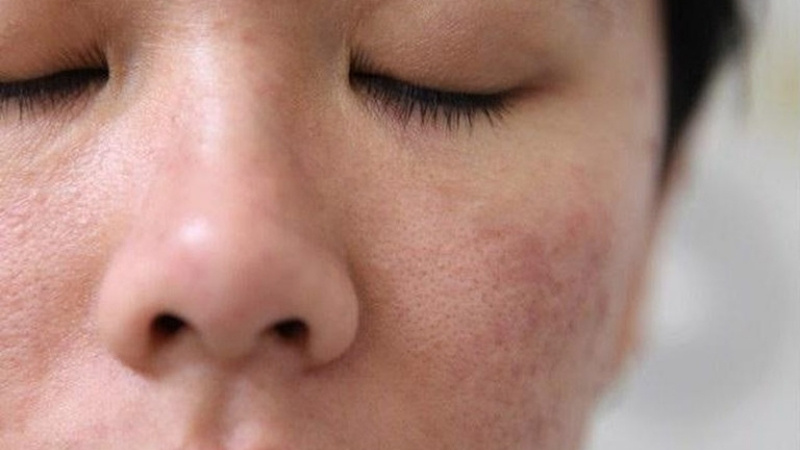 Người có vấn đề da liễu không nên tập nâng cơ mặt Người có vấn đề da liễu không nên tập nâng cơ mặt