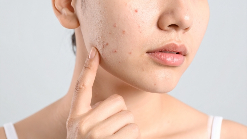 Tránh chạm tay giúp ngăn vi khuẩn xâm nhập và giảm chăm sóc da sau khi lấy nhân mụn lỗi Tránh chạm tay giúp ngăn vi khuẩn xâm nhập và giảm chăm sóc da sau khi lấy nhân mụn lỗi