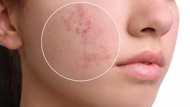 Vitamin E hỗ trợ làm mờ thâm