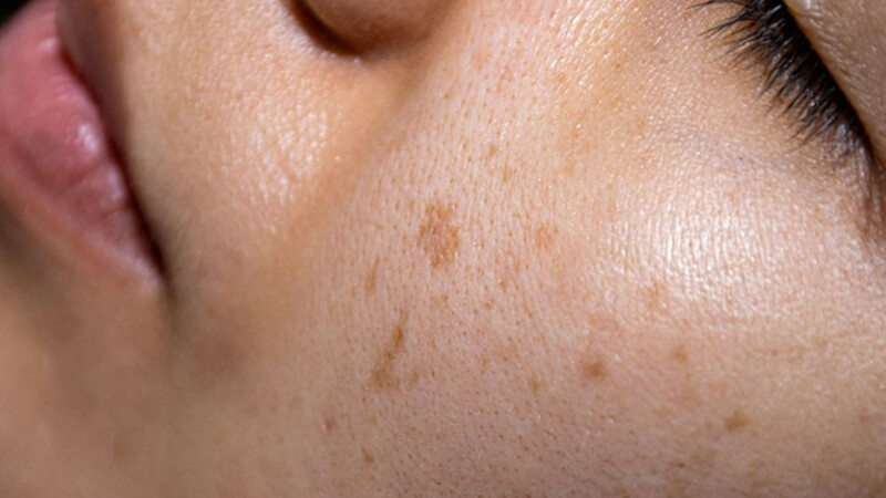 Đốm đen trên da mặt là gì? Đốm đen trên da mặt là gì?