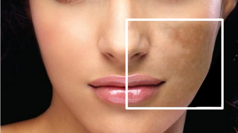 Các loại đốm đen phổ biến trên da Các loại đốm đen phổ biến trên da