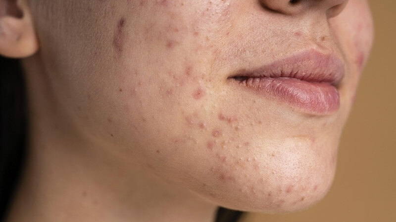 Các loại đốm đen phổ biến trên da Các loại đốm đen phổ biến trên da