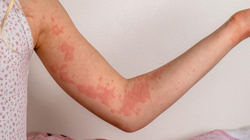 Triệu chứng dị ứng da thời tiết Triệu chứng dị ứng da thời tiết