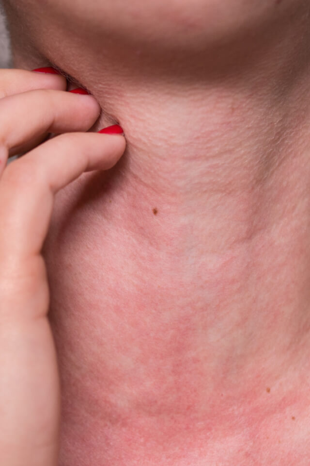 Dị ứng da thời tiết: Cách nhận biết và phòng ngừa hiệu quả