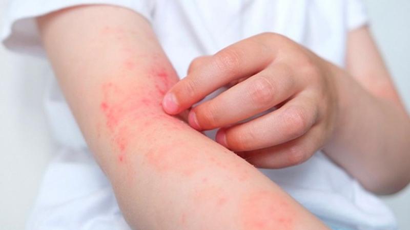 Da nhạy cảm hoặc cơ địa dễ dị ứng Da nhạy cảm hoặc cơ địa dễ dị ứng