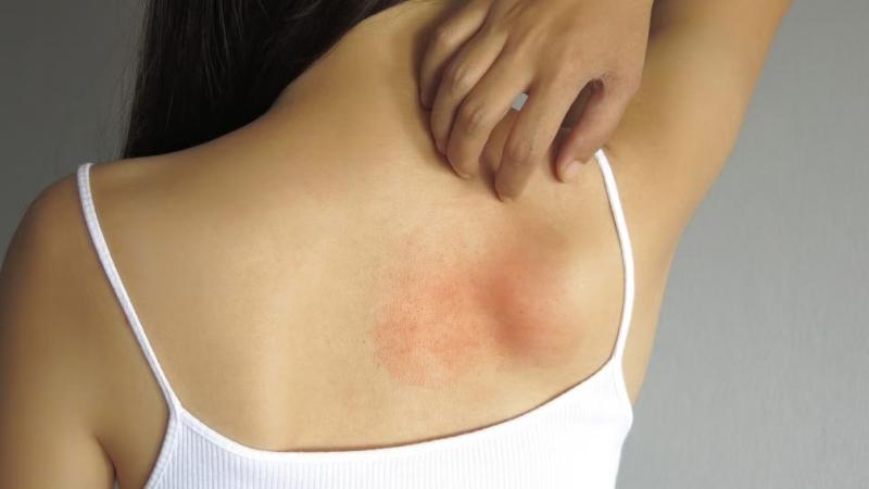 Cách phòng ngừa dị ứng da thời tiết Cách phòng ngừa dị ứng da thời tiết
