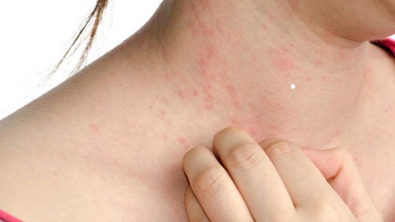 Dị ứng da thời tiết là gì? Dị ứng da thời tiết là gì?