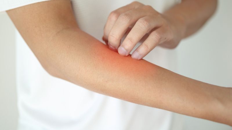 Những sai lầm khi trị viêm da cơ địa tại nhà