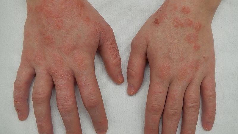Tay bị viêm da cơ địa