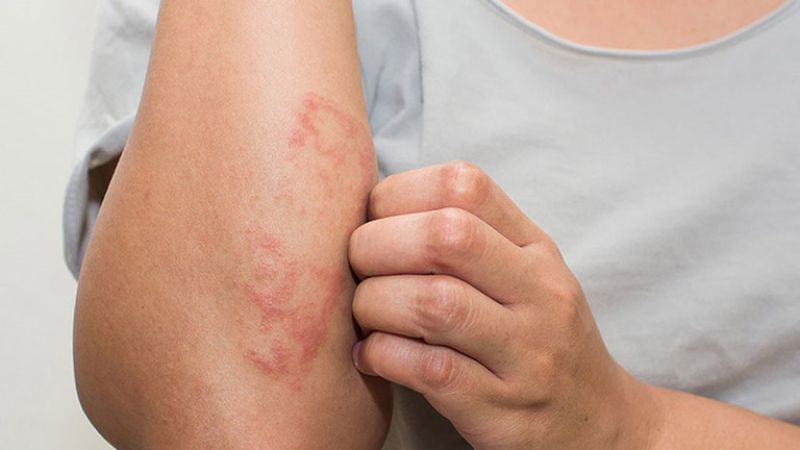 Dấu hiệu nhận biết viêm da cơ địa