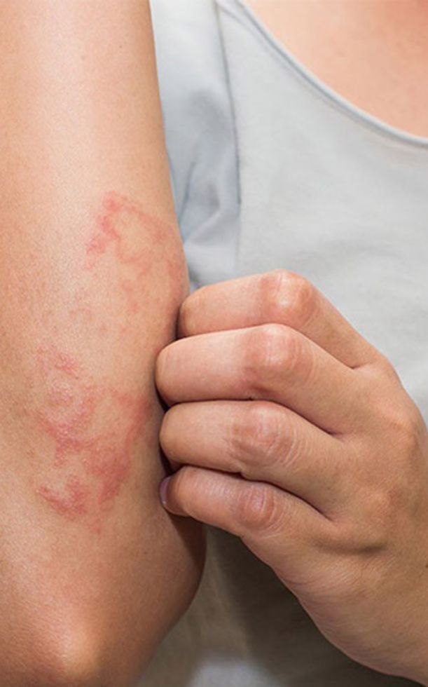 Cách trị viêm da cơ địa tại nhà hiệu quả và an toàn từ A-Z