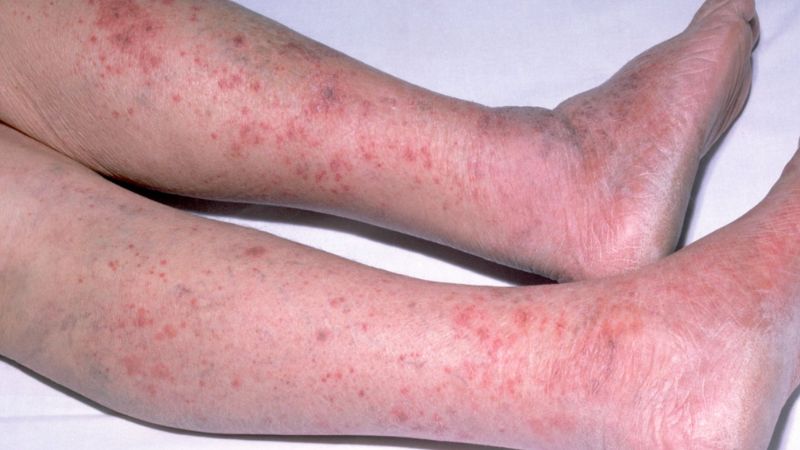 Cách phòng ngừa viêm não mô cầu hiệu quả nhất