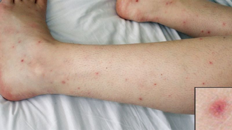 3 con đường lây lan âm thầm của vi khuẩn não mô cầu