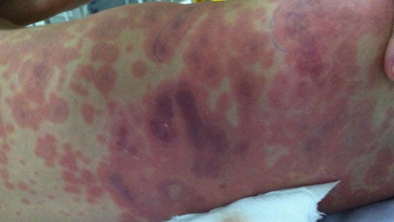 Tiếp xúc với người bệnh bao lâu thì hết nguy cơ lây nhiễm?