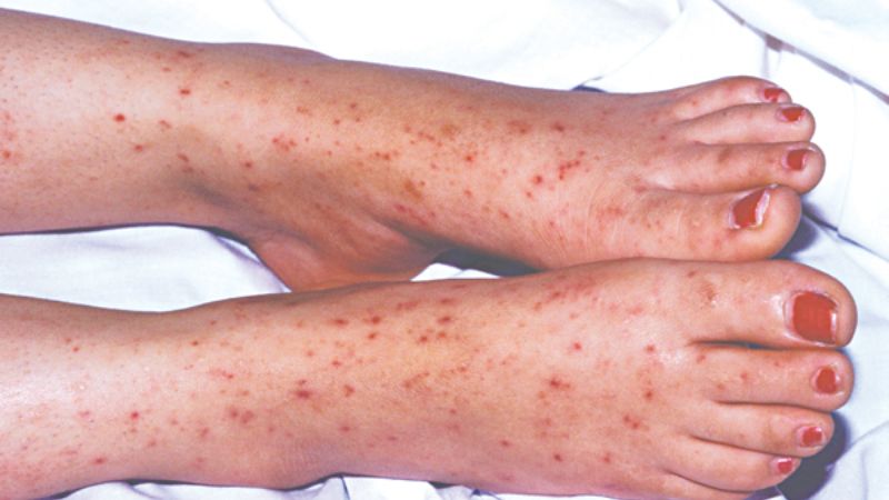 Thời gian ủ bệnh và các đối tượng dễ bị lây nhiễm nhất