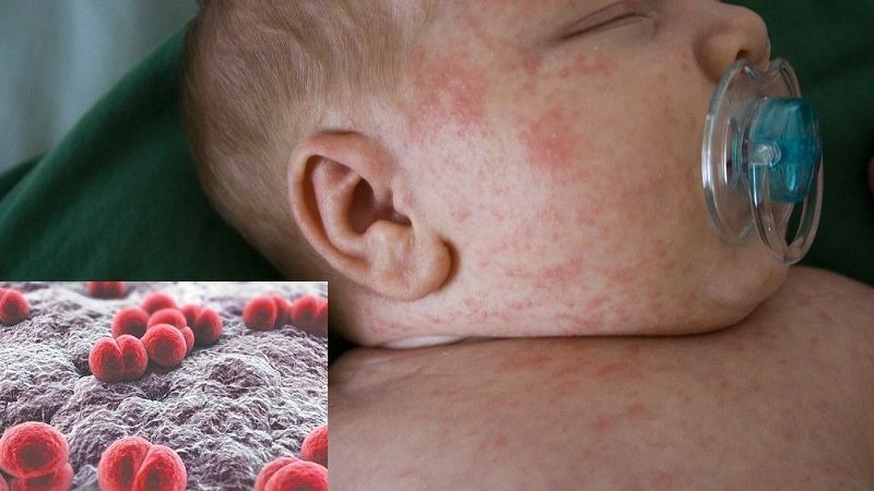 Viêm não mô cầu được xếp vào nhóm bệnh lây nhiễm nguy hiểmViêm não mô cầu được xếp vào nhóm bệnh lây nhiễm nguy hiểm