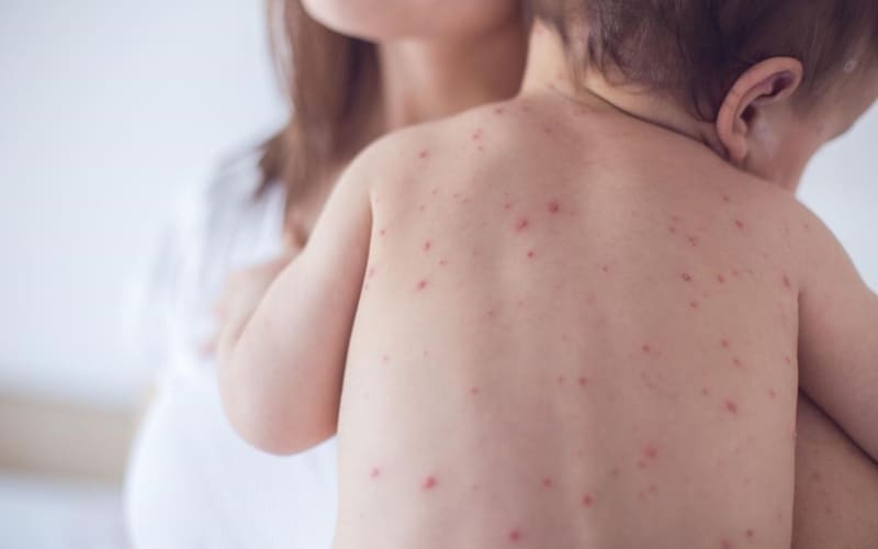 Nghiệm pháp ấn kính nhận biết tử ban tại nhà.