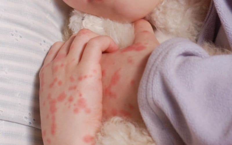 Các dấu hiệu thần kinh bắt đầu xuất hiện.