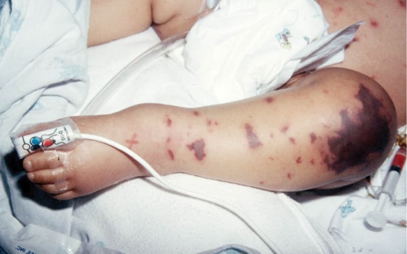 Viêm não mô cầu nhầm sốt xuất huyết nguy hiểm.