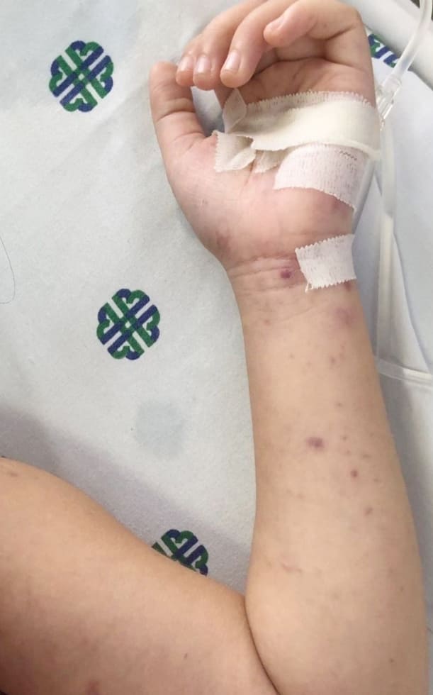 Bệnh viêm não mô cầu ở trẻ em: Dấu hiệu nhận biết và Lịch tiêm