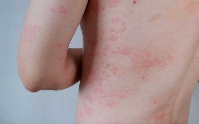 Cơ thể xuất hiện các dấu hiệu nóng trong rõ rệt cần nhận biết sớm.