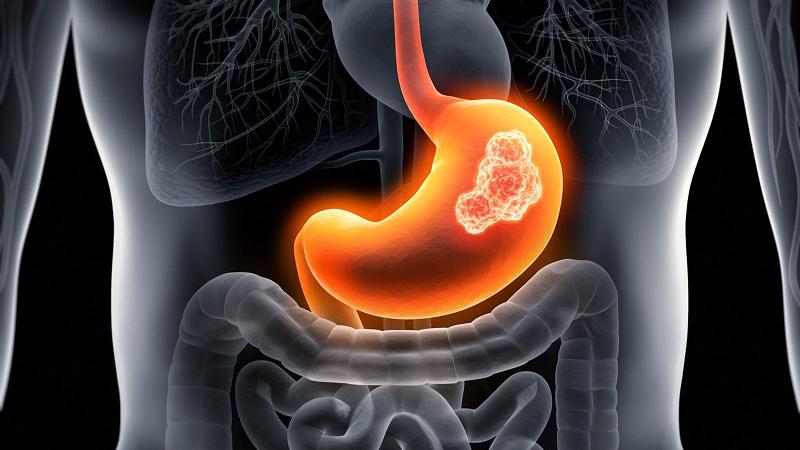 Người có tiền sử bệnh lý dạ dày uống nước khoáng được không?