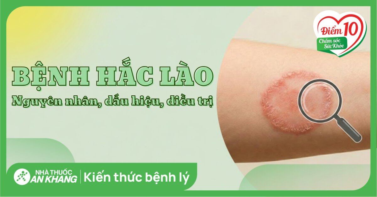 Bệnh hắc lào: Nguyên nhân, dấu hiệu, cách điều trị