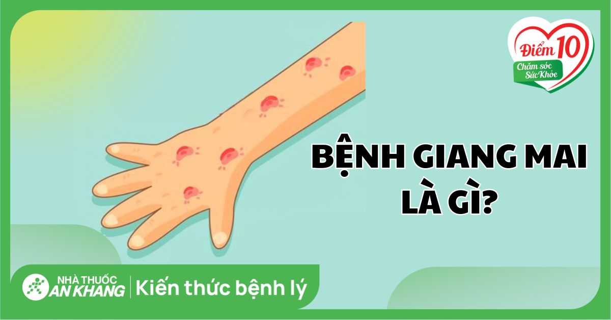 Giang mai: Dấu hiệu các giai đoạn, cách điều trị