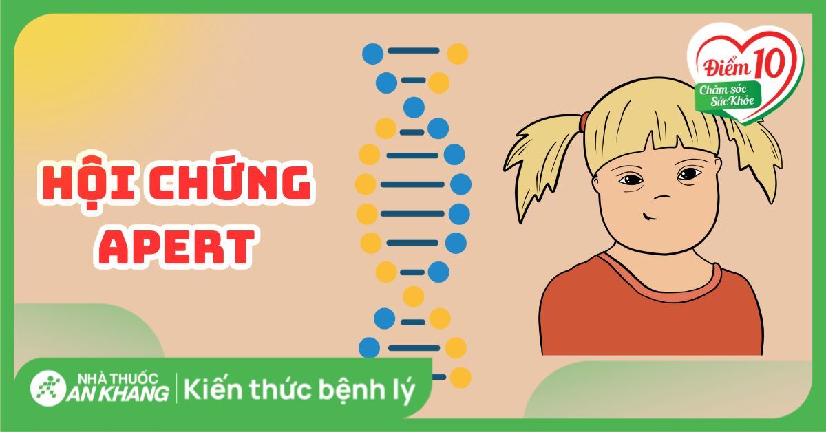 Hội chứng Apert: Nguyên nhân, dấu hiệu và cách điều trị