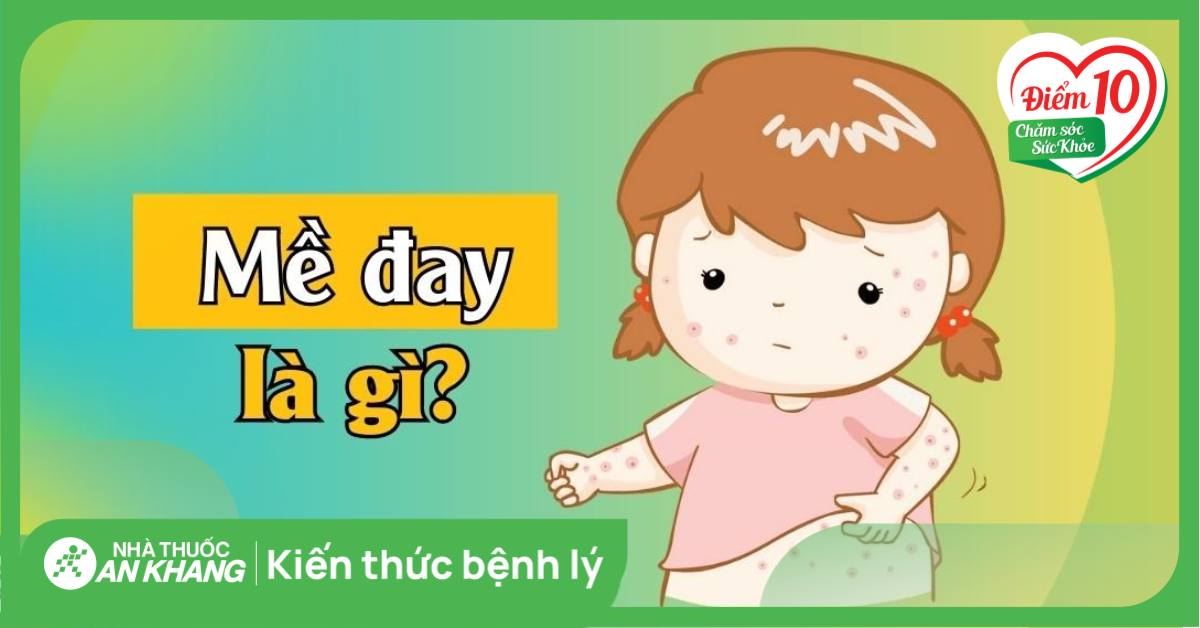 Mề đay (mày đay): Nguyên nhân và những cách điều trị hiểu quả
